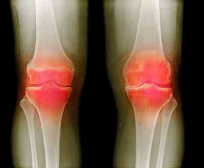 La artritis deteriora la capacidad laboral