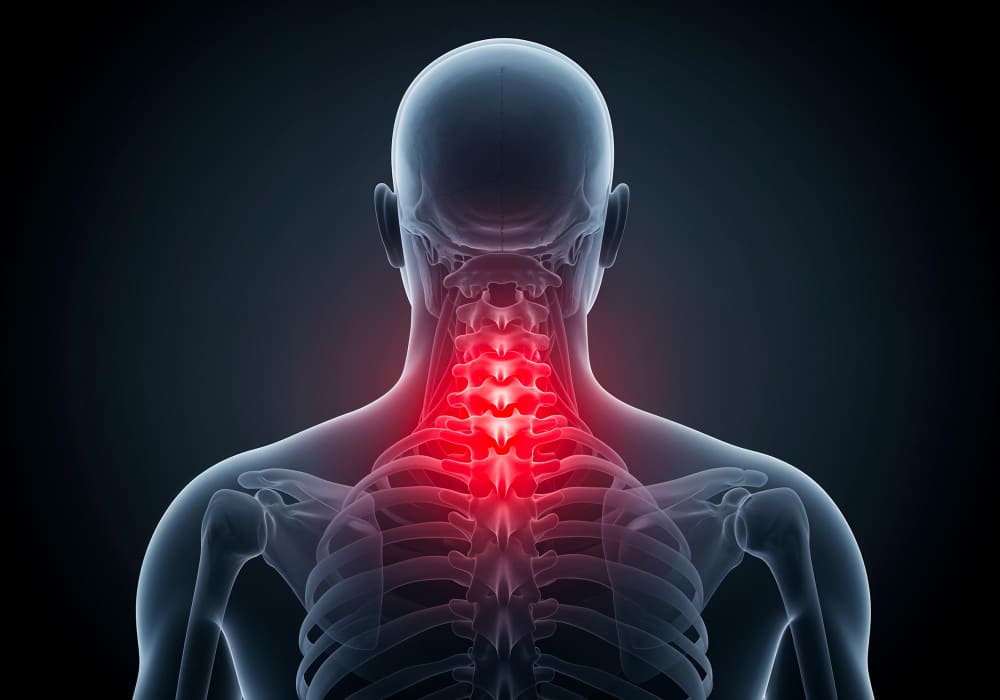 Incapacidad por radiculopatía cervical con pérdida de fuerza